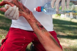 What to Do If You Get Severely Burned